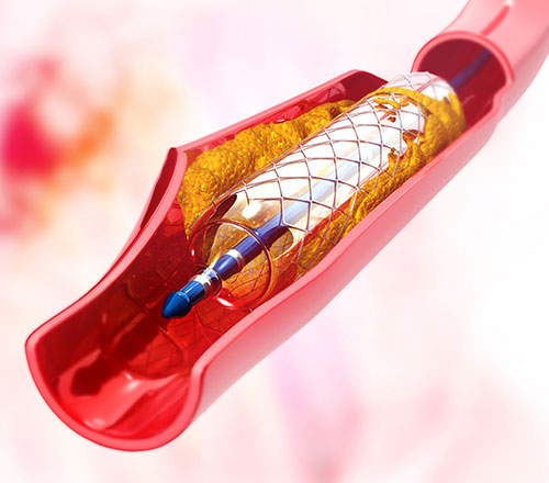 Heart stent