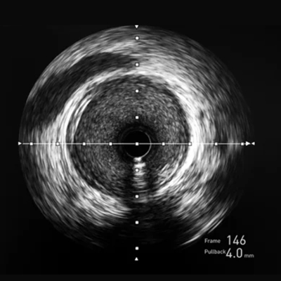 Importance of High Definition Intravascular Imaging