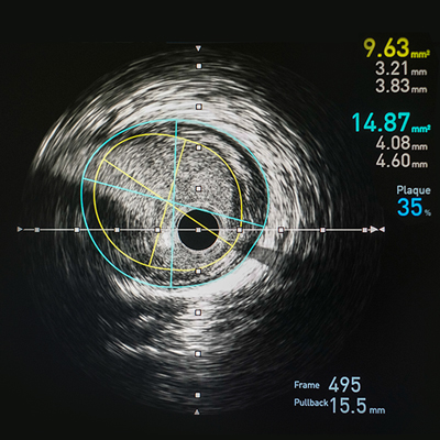 Know About Coronary Intravascular Imaging