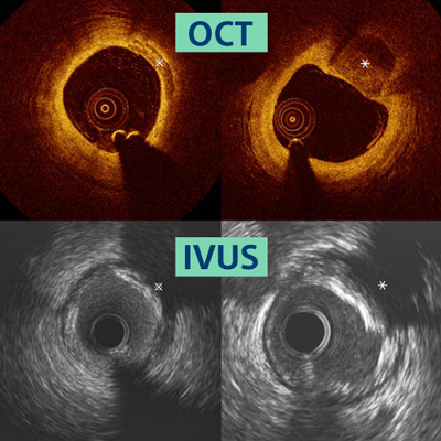 Types of High-Definition Intravascular Imaging