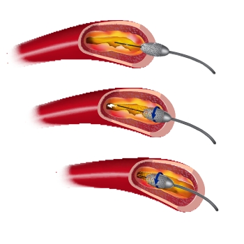 Cutting Balloon Angioplasty for Stent Restenosis