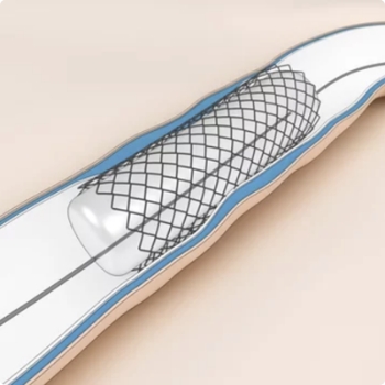 Stent Restenosis Mechanism and Its Symptoms