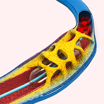 Understanding Heart Attacks and Angioplasty