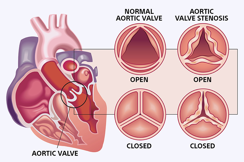 Severe Aortic Stenosis