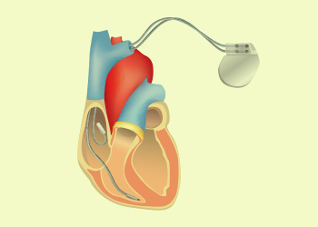 Implantable cardioverter-defibrillator (ICD)