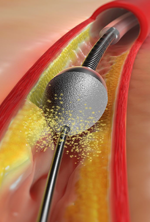 Calcium Debulking Technology - Rotational Atherectomy and Cutting Balloons