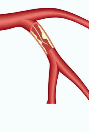 Low Contrast PCI for Kidney Patients