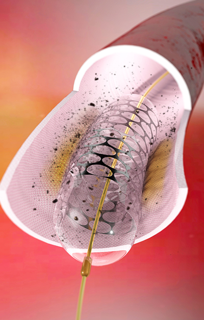 Benefits of Biodegradable Polymer Drug-Eluting Stents