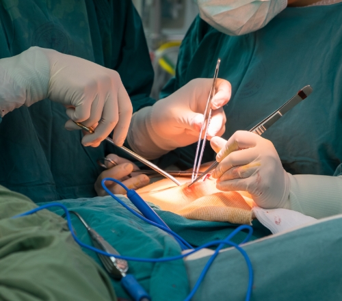 Coronary Artery Bypass Grafting