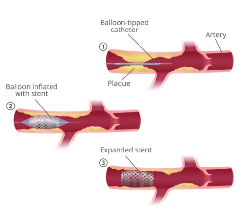 Angioplasty and Stent placement